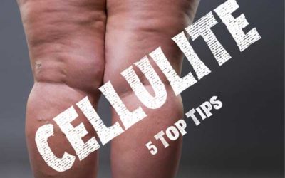 Cellulite and what to do about it.